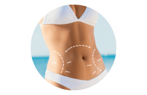 Tummy tuck