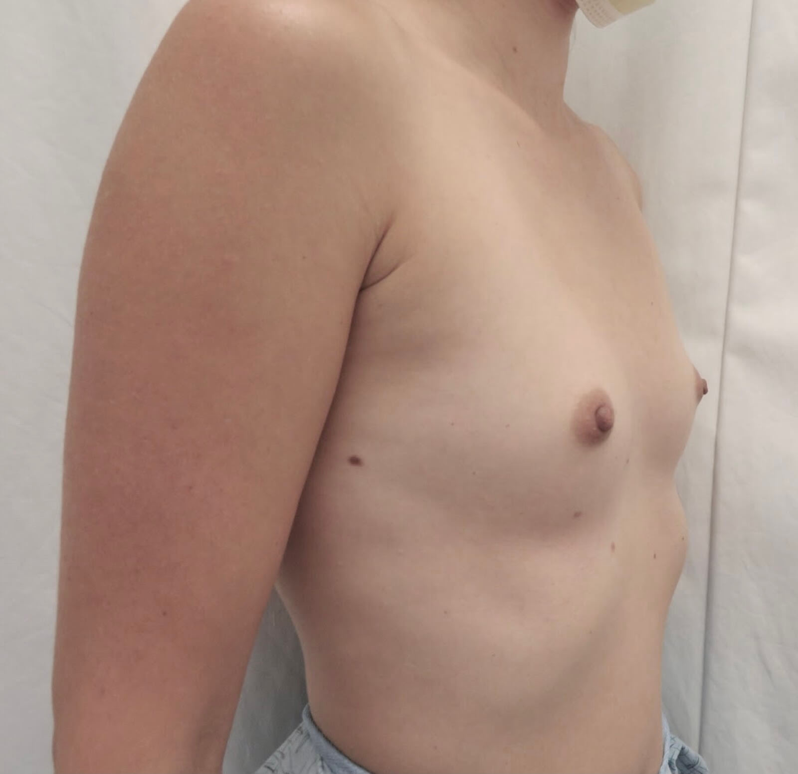 924789AC-85F9-47C1-B96F-BC2B16397260 (1) Avant Augmentation Mammaire