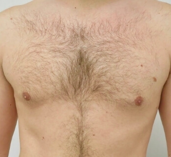 Gynecomastia 5 after