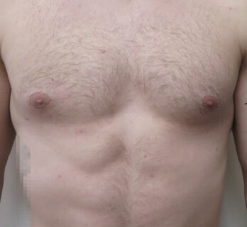 Gynecomastia