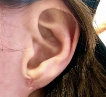 Chirurgie de l'oreille