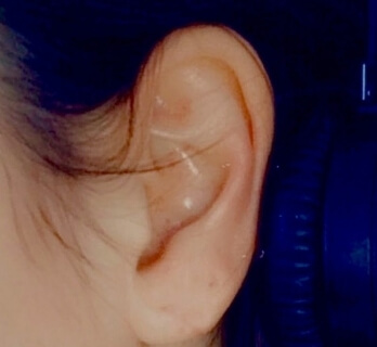 Ear lobe