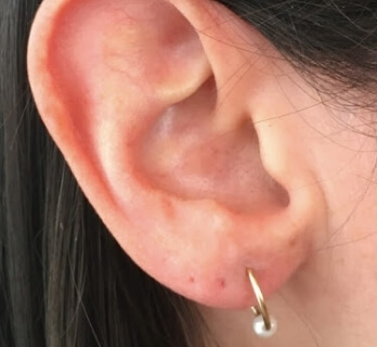 Chirurgie de l'oreille