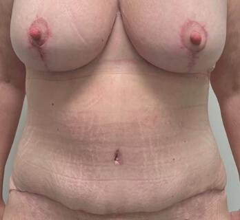 breast surgery