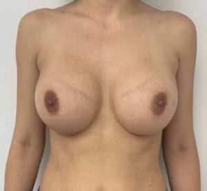 breast surgery