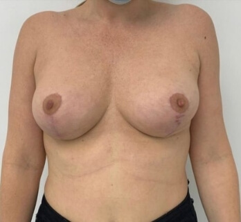 Breast surgery