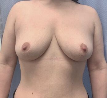 breast surgery