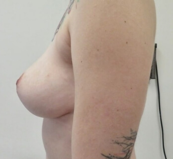 chirurgies des seins