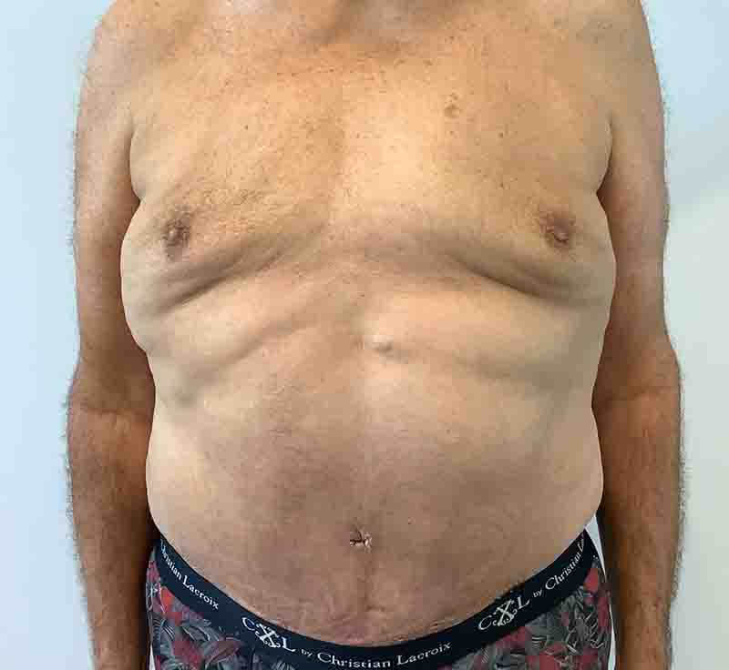 Abdominoplastie