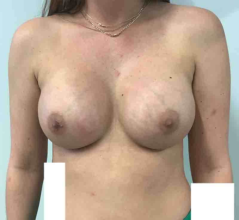 breast surgery