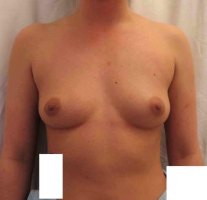 Avant augmentation mammaire