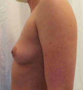 Avant augmentation mammaire