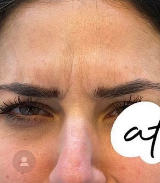 Botox1after