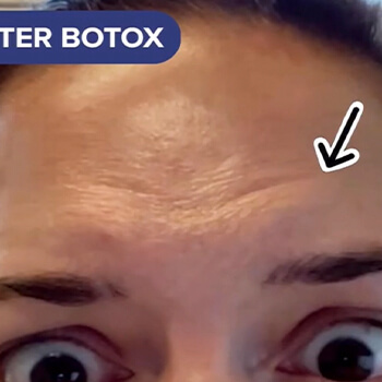 Botox