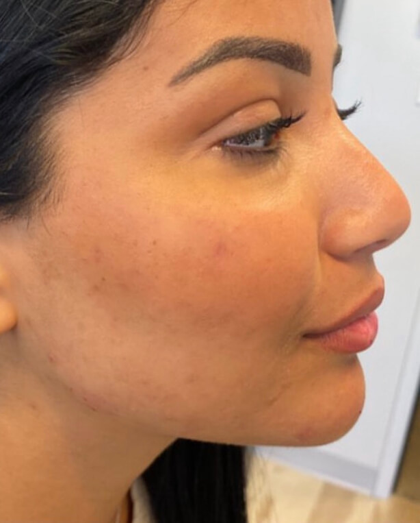 Chinfillersafter (1)