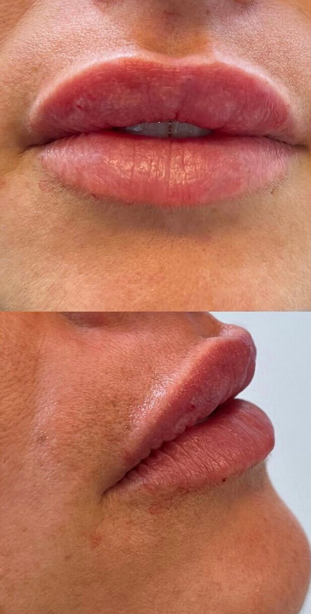 Filler2after (1) (1)