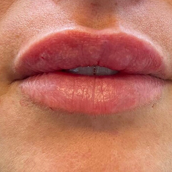 Lip Fillers