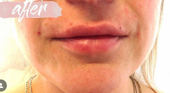 Lip Fillers