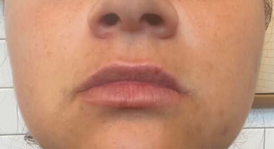 Lip Fillers