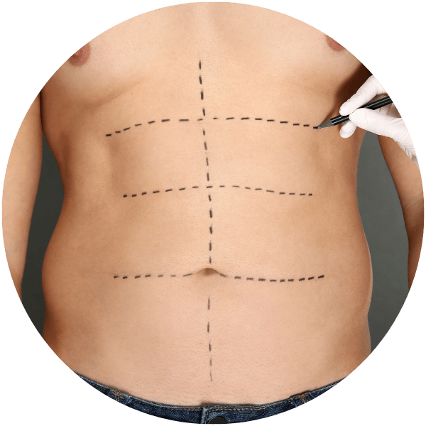 Untitled design (9) (1) Male Abdominoplasty