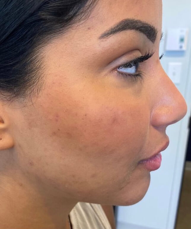 chinfillersbefore (1)