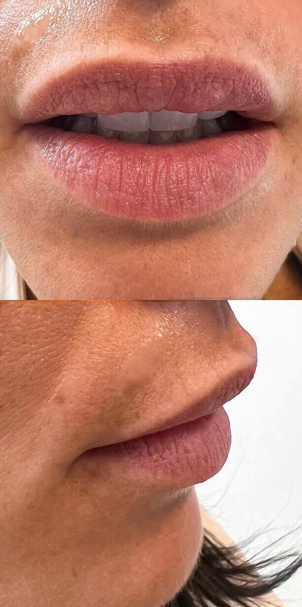 fillers2before (1) (1)