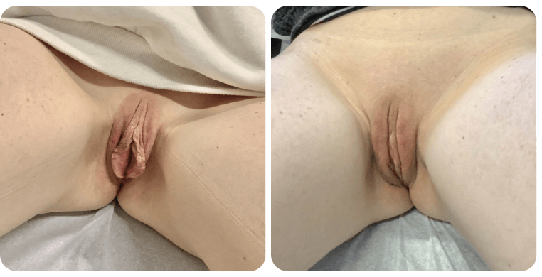 Beforeandafterlabia1 (2)