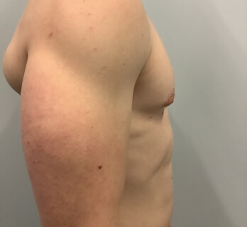 Gynecomastia
