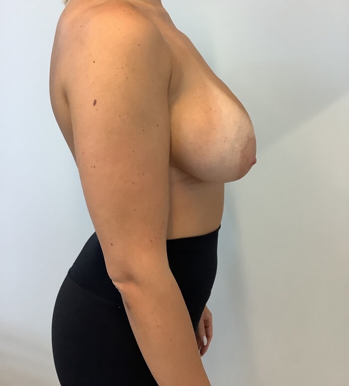 changementimplants4avantb_1 (1)