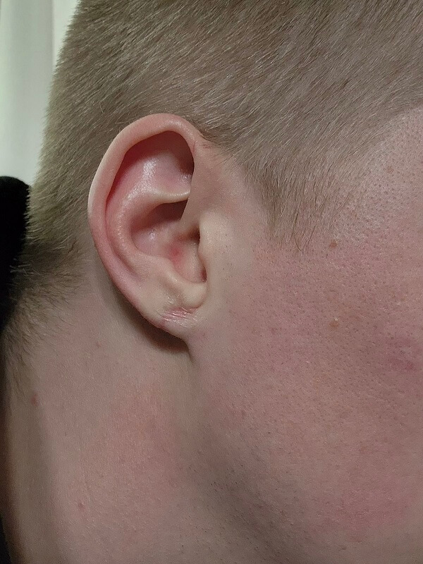 Earlobe10AFTER_1 (1)