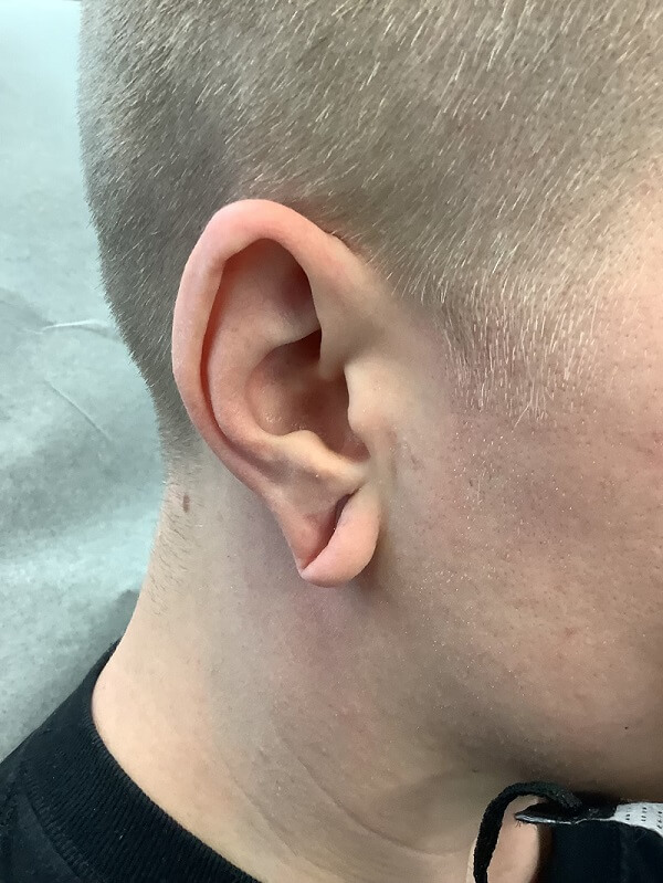 Earlobe10BEFORE_1 (1)