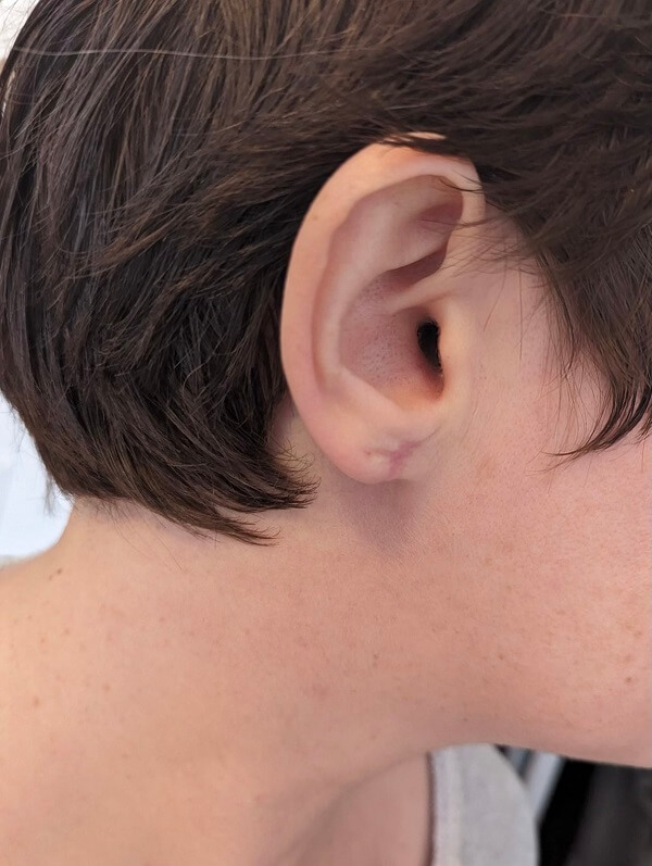 Earlobe11AFTER_1 (1)