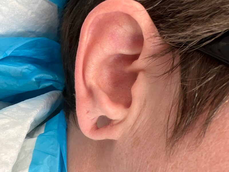 Earlobe11BEFORE_1 (1)