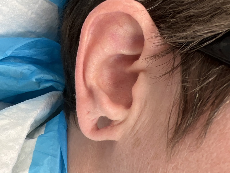 Earlobe11BEFORE_1