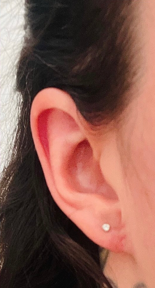 Earlobe12AFTER (1)