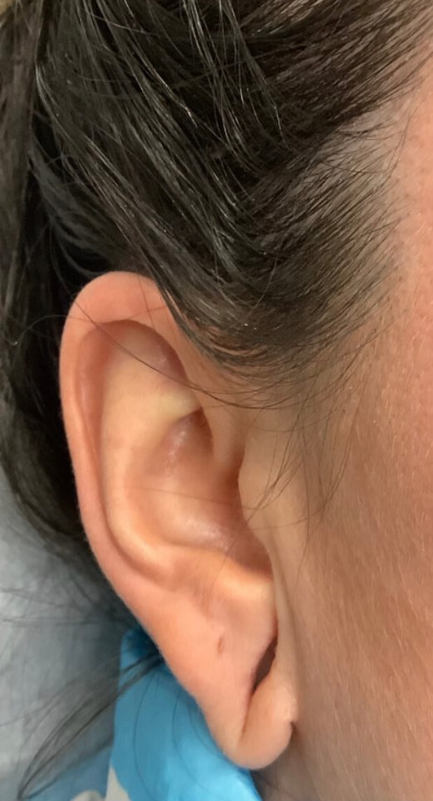 Earlobe12BEFORE (1)