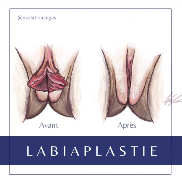 labiaplasty-2-before-after labiaplasty before after