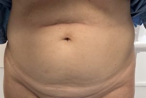 Abdominoplastie avant chirurgie