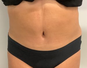 Après abdominoplastie
