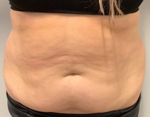 avant abdominoplastie