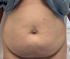 abdominoplastie avant